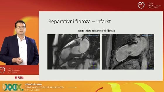 video: FIBRZA MYOKARDU A JEJ DETEKCE MAGNETICKOU REZONANC - PROGNOSTICK VZNAM