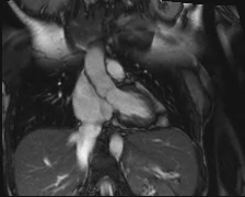 file_5e6a0a599f49b_110_video13_MRI-LVOT.mp4.mp4