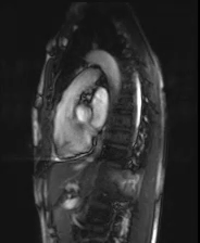 file_5e6a0a5a78bd5_110_video15_MRI-RV-inflow-outflow2.mp4.mp4