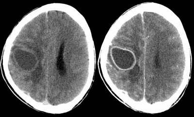 Obr. 03 CT mozku nativ-kontrast