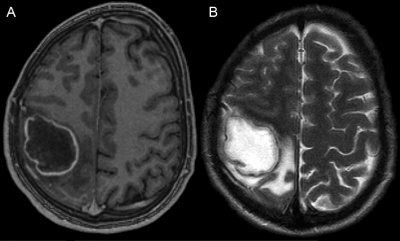 Obr. 04 MRI mozku