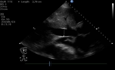 Obr. 1  (C) Dilatovan doln dut la (2,78 cm) a patrn ascites.