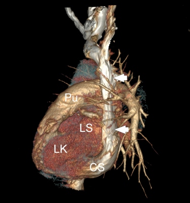 Obr. 2 C  CT angiografie s planrn rekonstrukc v ikm parakoronln rovin (A) a s volumovou rekonstrukc v elnm (B) a levm bonm (C) pohledu. Na obrzcch je patrn perzistujc levostrann vena cava superior (ipky) jdouc vlevo laterln podl lev sn (LS) a komory (LK) a stc do dilatovanho koronrnho sinu (CS) a do prav sn (PS). Pro anatomickou pehlednost je oznaena tak aorta (Ao), plicnice (Pu), prav komora (PK) a lev s (LS).