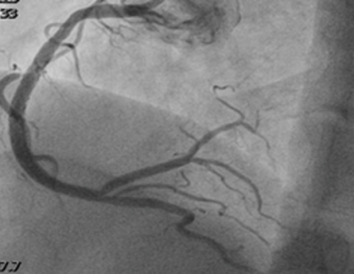 Obr. 10  Finln vsledek po implantaci stent (Cre8 EVO 3,5  46 mm a 3,5  20 mm) a postdilatace non-compliantnm balonkovm kattrem Pantera LEO 4,0  20 mm v celm rozsahu 