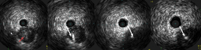 Obr. 5  IVUS zaveden do ramus ventricularis a za real-time kontroly IVUS byla provedena spn punkce proximln sti uzvru CTO (erven ipka) vodiem Confianza Pro (ASAHI INTECC) (bl ipka).