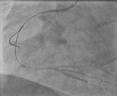 Obr. 6  Rekanalizan vodi Fielder XT v nstnn disekci tepny subintimln, kde byl ponechn na mst jako marker wire.