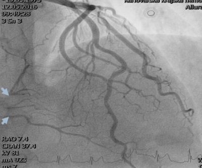 Obr. 2  Diagnostick nstik lev vnit tepny  patrn jsou okrajov nerovnosti na ramus interventricularis anterior a plnn periferie prav vnit tepny nkolika septlnmi kolaterlami (modr ipky).