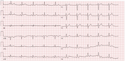 Obr. 2  Klidov EKG
