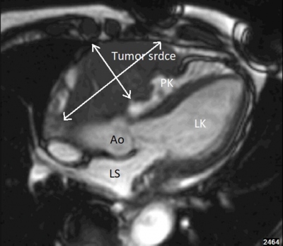 Obr. 2  Magnetick rezonance srdce, tydutinov projekce  patrn je tumorzn infiltrace stny prav komory a prav sn. Ao  aorta; LK  lev komora; LS  lev s; PK  prav komora; PS  prav s. 