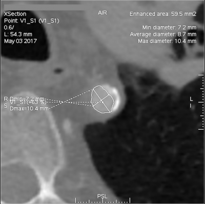 Obr. 4  CT angiografie nejmen prmr aorty necelch 9 mm