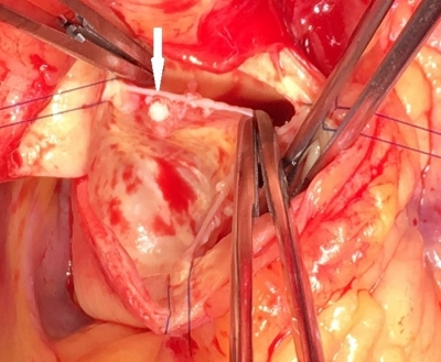 Obr. 3  Papilrn fibroelastom, perioperan