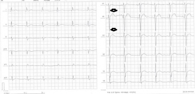 Obr. 1  EKG pacienta ped operac. ipky oznauj zmny repolarizan fze.