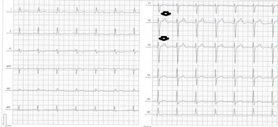 Obr. 2  EKG pacienta po operaci. ipky oznauj vvoj zmn repolarizan fze.