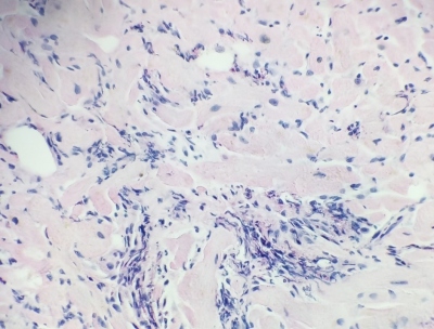 Fig. 2  Eosinophilic infiltrate of the myocardial interstitium.