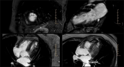 Obr. 3  Magnetick rezonance: zobrazen jizvy pozdnm sycenm gadoliniem v segmentu 16 (ppad 2)