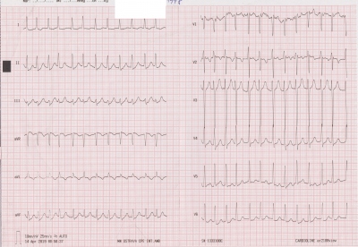 Obr. 6  EKG natoen na emergentnm pjmu s odstupem dvou dn po proputn, kde vidme fibrilaci sn s rychlou odpovd komor, deprese seku ST do 0,5 mm ve II, III, aVF.