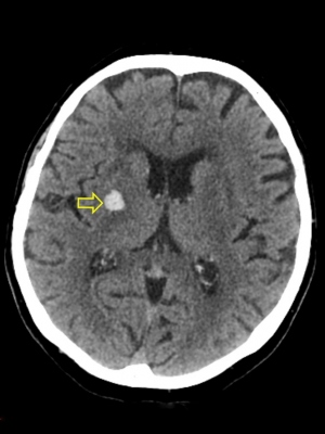 Obr. 1  Prvn snmek ze dne 15. 2. 2018 ukazuje mal intracerebrln hematom v corona radiata v blzkosti capsula interna velikosti 12  10  20 mm.