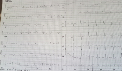 Obr. 5  EKG kivka 24 h po pijet na JIP, 24 h po podn trombolytick terapie