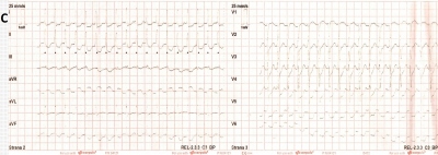 Obr. 1  (A, C) Na EKG provedenm RZS byla iniciln registrovna setrval zkokomplexov tachykardie s frekvenc 220/min s nespecifickmi zmnami ve smyslu difuznch depres seku ST a elevace v aVR. (B) Po intravenzn aplikaci 150 mg amiodaronu RZS byla na EKG zejm fibrilace sn s komorovou odpovd okolo 150/min s stupem ischemickch zmn. (D) Na naem pracoviti byla na vstupnm EKG pravideln zkokomplexov tachykardie s frekvenc 156/min.