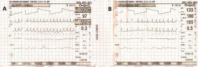 Obr. 1  (A, C) Na EKG provedenm RZS byla iniciln registrovna setrval zkokomplexov tachykardie s frekvenc 220/min s nespecifickmi zmnami ve smyslu difuznch depres seku ST a elevace v aVR. (B) Po intravenzn aplikaci 150 mg amiodaronu RZS byla na EKG zejm fibrilace sn s komorovou odpovd okolo 150/min s stupem ischemickch zmn. (D) Na naem pracoviti byla na vstupnm EKG pravideln zkokomplexov tachykardie s frekvenc 156/min.