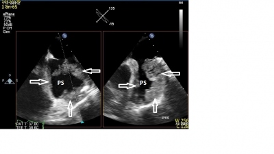 Obr. 2  Jcnov echokardiografie (X-plane zobrazen prav sn). Stna cel prav sn (PS) je pokryta izoechogennmi nstnnmi hmotami tlouky 1,52 cm (ipky), pod Eustachovou chlopn z nich vychz kekovit, velmi mobiln tvar dlky a 5 cm, kter sah a k trikuspidln chlopni. 