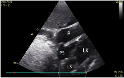 Obr. 4  Transtorakln echokardiografie. Perikardiln vpotek se znmkami tampondy, utlaen PK oznaena ipkou. LK  lev komora; LS  lev s; P  perikardiln vpotek; PS  prav s.
