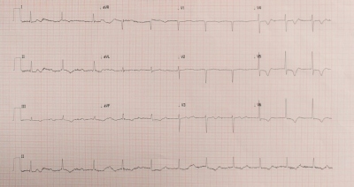Fig. 1  Baseline ECG. 