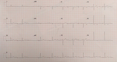 Fig. 2  ECG repeated at 30 minutes.