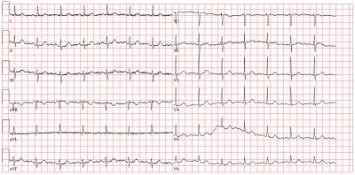 Obr. 2  EKG v odstupu dvou let