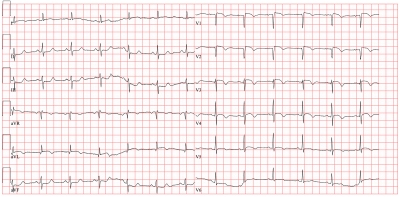 Obr. 1  EKG za hospitalizace s pracovn diagnzou akutnho koronrnho syndromu