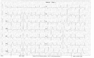 Obr. 2  EKG zznam z ergometrie. Na zznamu jsou na vrcholu zte patrn komplexn formy komorov arytmie  triplet KES s alternujc osou komplex QRS.