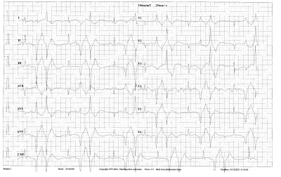 Obr. 3  EKG zznam z kontroln ergometrie. Pi terapii maximln tolerovanou dvkou carvedilolem petrvvaj na vrcholu zte bidirekn kuplety KES, efekt lby je nedostaten.