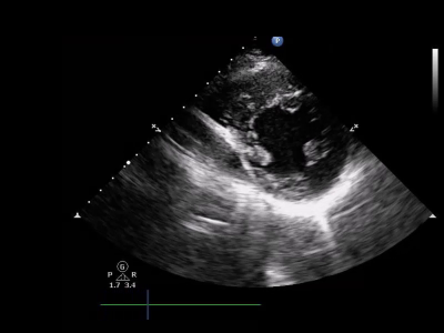 file_604257df9b3a7_140_Video_2_Echokardiografie,_bez_znamek_cor_pulmonale.mp4.mp4