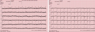 Obr. 1  EKG s obrazem STEMI spodn a zadn stny lev komory