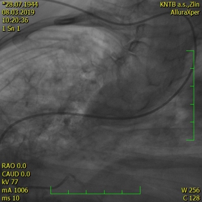 Obr. 2  Koronarografie  pedozadn projekce na levou vnitou tepnu s extrmnm vinutm aorty pi tk kyfoskolize