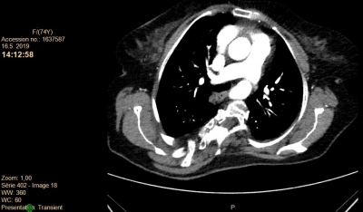 Obr. 3  CT angiografie aorty  transverzln ez bez prkazu disekce ascendentn aorty