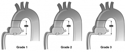 Obr. 4  Rozdlen aortokoronrnch disekce dle Dunninga a spol.14