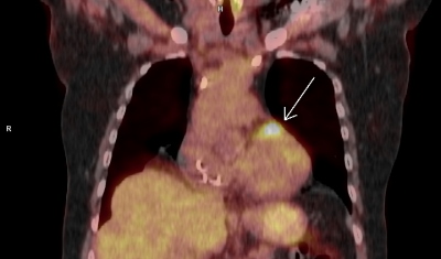 Obr. 3 A – PET/CT myokardu a plic (A, B, C, D), přetrvávající okrsek vyšší metabolické aktivity (šipka) v oblasti bazální poloviny přední stěny levé komory. Laskavě zapůjčila MUDr. M. Jarůšková, ONM – PET centrum, Nemocnice Na Homolce.