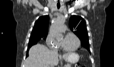 Obr. 3 B – PET/CT myokardu a plic (A, B, C, D), přetrvávající okrsek vyšší metabolické aktivity (šipka) v oblasti bazální poloviny přední stěny levé komory. Laskavě zapůjčila MUDr. M. Jarůšková, ONM – PET centrum, Nemocnice Na Homolce.