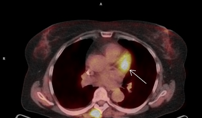 Obr. 3 C – PET/CT myokardu a plic (A, B, C, D), přetrvávající okrsek vyšší metabolické aktivity (šipka) v oblasti bazální poloviny přední stěny levé komory. Laskavě zapůjčila MUDr. M. Jarůšková, ONM – PET centrum, Nemocnice Na Homolce.