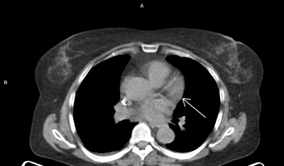 Obr. 3 D – PET/CT myokardu a plic (A, B, C, D), přetrvávající okrsek vyšší metabolické aktivity (šipka) v oblasti bazální poloviny přední stěny levé komory. Laskavě zapůjčila MUDr. M. Jarůšková, ONM – PET centrum, Nemocnice Na Homolce.