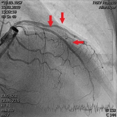 Obr. 2 � (B) Koronarografick� n�lez po prim�rn� PCI culprit l�ze na RIA, d�le o�et�ena tak� v�znamn� sten�za na RIM, �ipkami ozna�eny m�sta implantovan�ch stent�. PCI � perkut�nn� koron�rn� intervence; RIA � ramus interventricularis anterior; RIM � ramus intermedius.