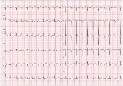 Obr. 1  EKG se sinusovou tachykardi a vertiklnm sklonem srden osy