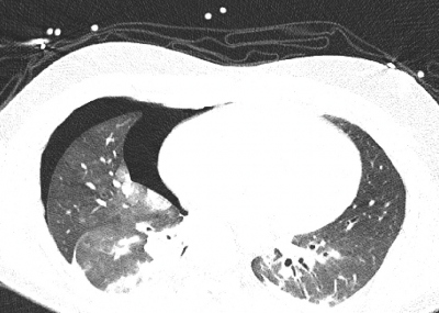 Obr. 5  Pravostrann pneumotorax. CT dokumentace zveejnna s laskavost KZM.