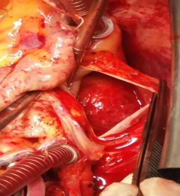 Fig. 1  Intraoperative finding. After incision of the left atrium, a smooth round thrombus was visualised.