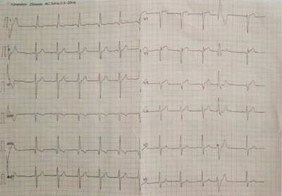 Fig. 1  ECG recorded from the patient K.: sinus rhythm, ventricular extrasystole, possible anteroseptal myocardial infarction, signs of left ventricular hypertrophy.