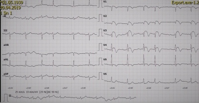 Obr. 1  EKG, anteroextenzivn elevace seku ST s negativnmi vlnami T, kmit Q ve svodech V1V2