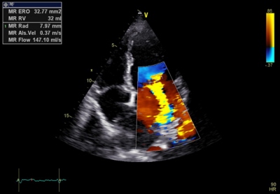 Obr. 4  Echokardiografie, apikln projekce, mitrln regurgitace III. stupn dle barevnho dopplerovskho mapovn, tvrt den po porodu