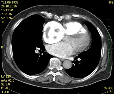 Obr. 1  CT angiografie plicnice, diagnostika pomoc pm vizualizace embolu zobrazen jako defekty kontrastn npln lumen
