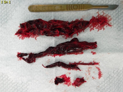Obr. 3  Postoperan chirurgick nlez po extrakci masivnch tromb z arteria pulmonalis a prav sn